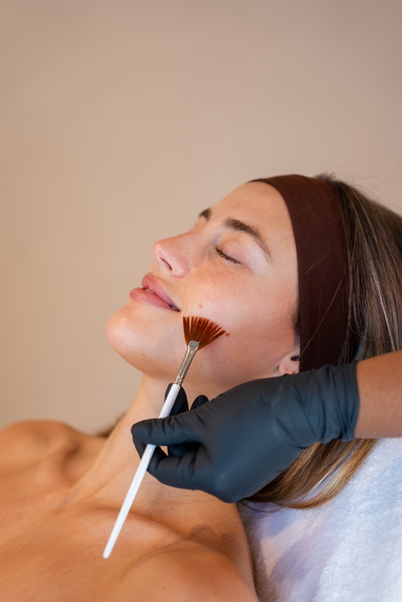 Chemische Peeling